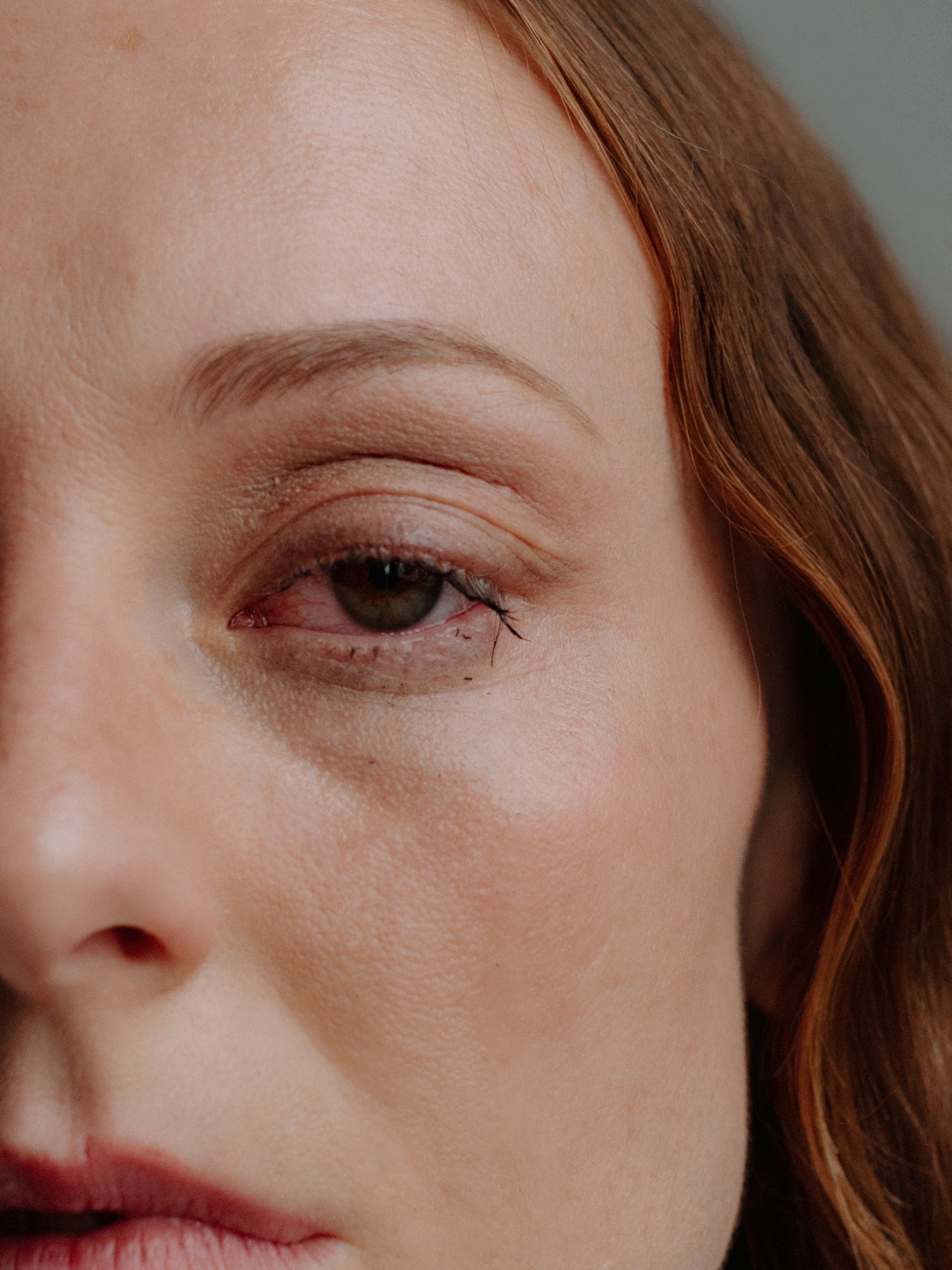 Stress and Skin: Why your breakouts, dark spots & redness might not be what you think