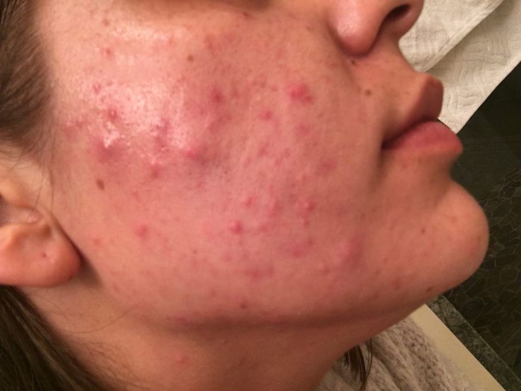 Hormones, Skin & Self-Care: Glow with confidence